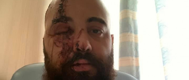Při bejrútském výbuchu byl zraněn bubeník metalové kapely Nervecell